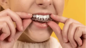 Clear aligners