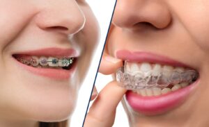 Braaces vs Invisalign