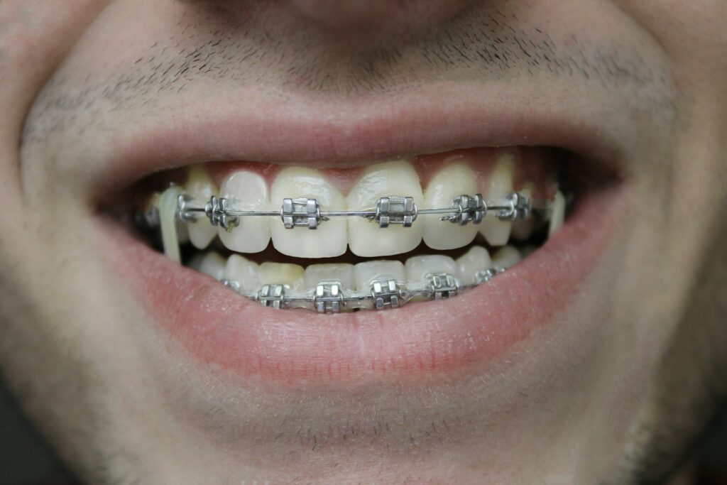 showing braces