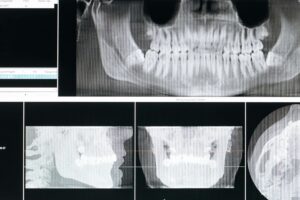 teeth xray